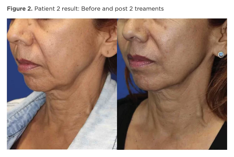 Figure 2. Patient 2 result: Before and post 2 treatments