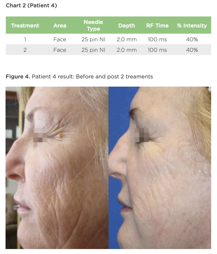 Figure 4. Patient 4 result: Before and post 2 treatments