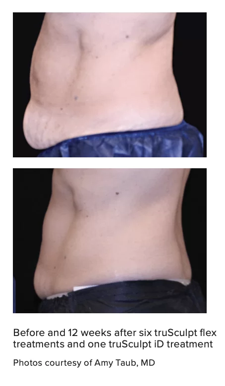 Before and 12 weeks after six truSculpt flex
treatments and one truSculpt iD treatment
